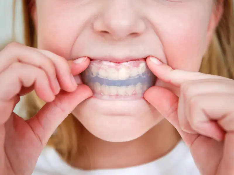 Custom mouth guards at Levin Dental Centre providing protection for teeth during sports and preventing dental injuries