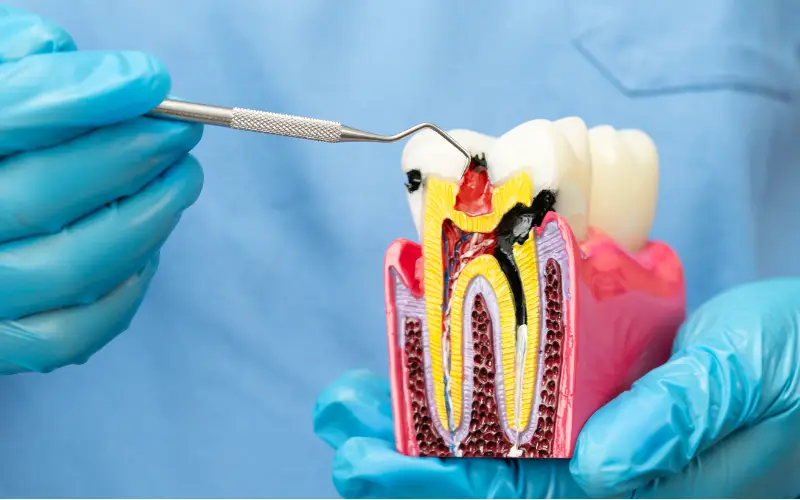 Root canal treatment at Levin Dental Centre providing expert care to save damaged teeth and relieve pain for patients in Levin