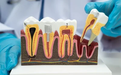 Root Canal Cost NZ: What Levin Patients Should Know Before Treatment