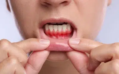 Gum Disease Treatment Levin: Early Signs, Effective Care, and Prevention Tips