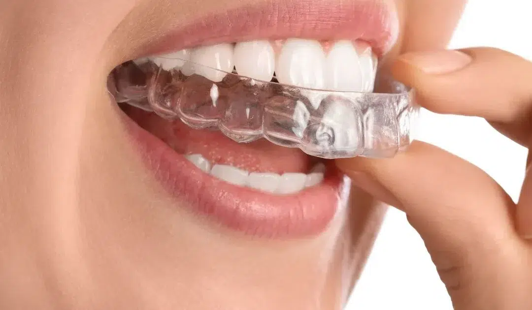 Dental mouth guard designed to help prevent teeth grinding, reduce jaw pain, protect teeth from wear, and improve sleep comfort.