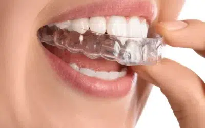 Dental Mouth Guard Helps Prevent Teeth Grinding and Jaw Pain
