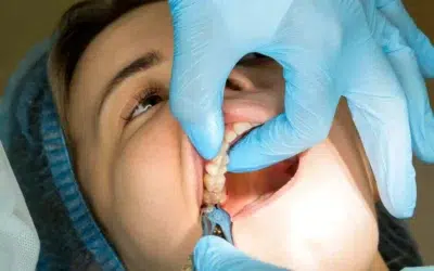 Wisdom Teeth Removal Cost in New Zealand: What Affects the Price and Your Treatment Options