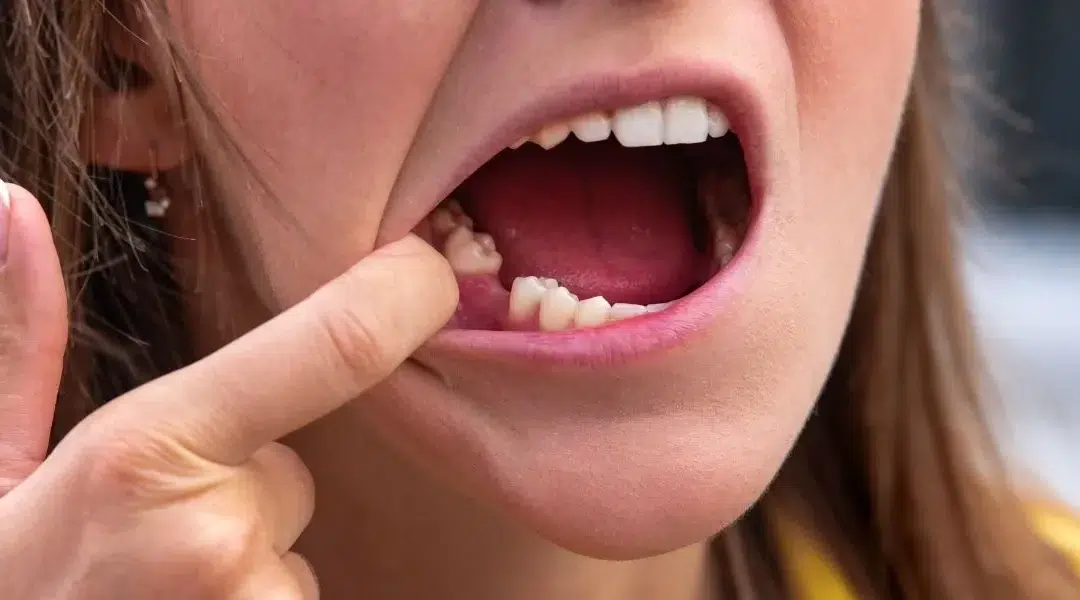 Cracked Tooth Levin – Emergency Dental Care and Treatment by Dentists