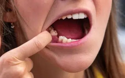 Cracked Tooth levin: What to Do, When It’s an Emergency & How Dentists Treat It