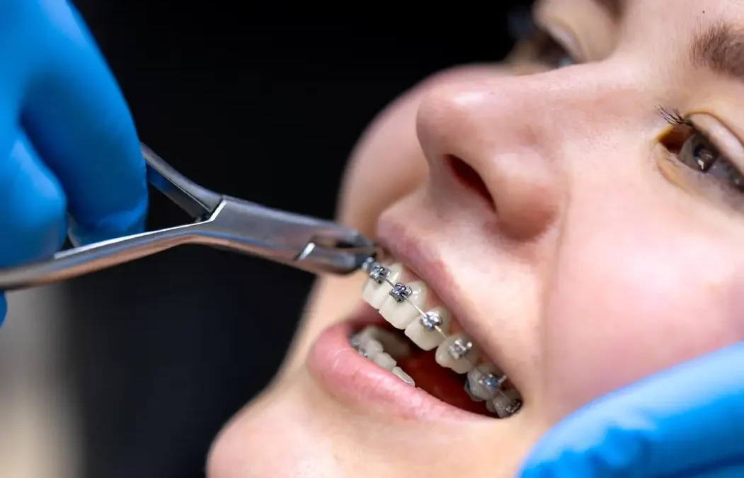 braces cost levin nz