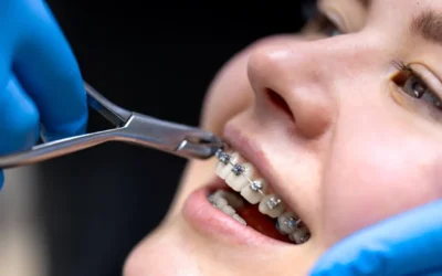 Braces Cost Levin NZ: What You Can Expect to Pay for Orthodontic Treatment